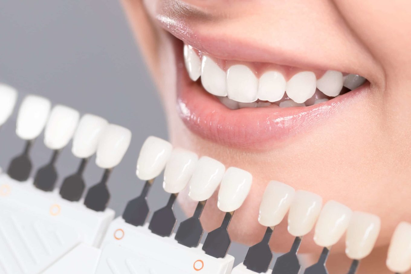 In Office Professional Teeth Whitening - The Key To A Perfect Smile