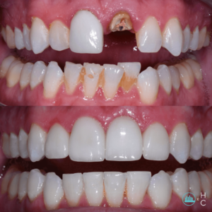 dead tooth before and after