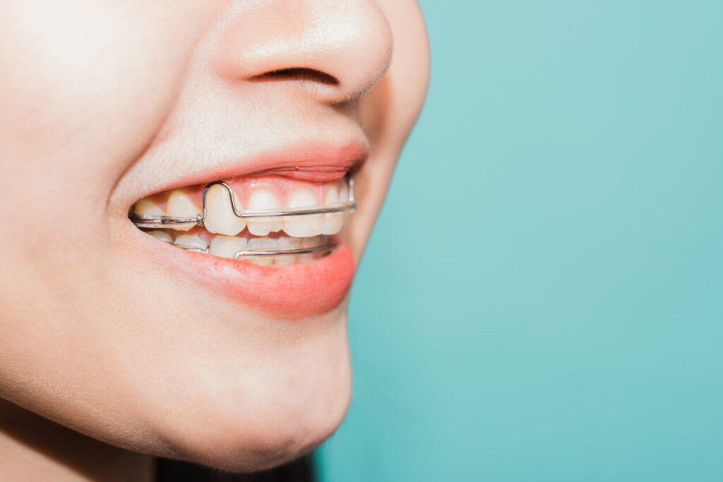 braces or invisalign