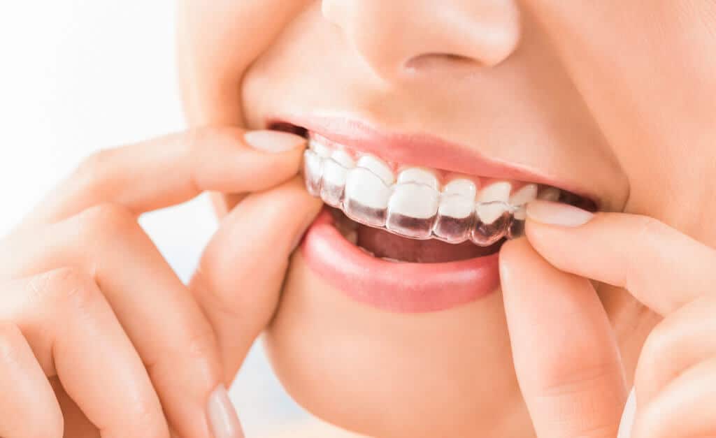 invisalign faq