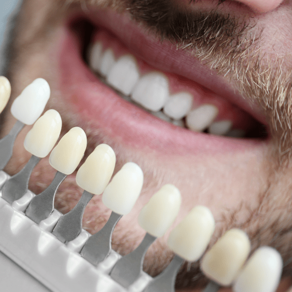 dental veeners